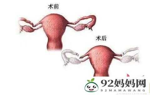  切除一侧卵巢对女性有什么影响「卵巢和输卵管切除的危害」