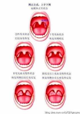 扁桃体发炎是什么导致 扁桃体发炎什么引起的