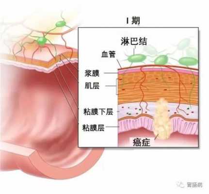 预后较差是什么意思（肿瘤预后较差是什么意思）