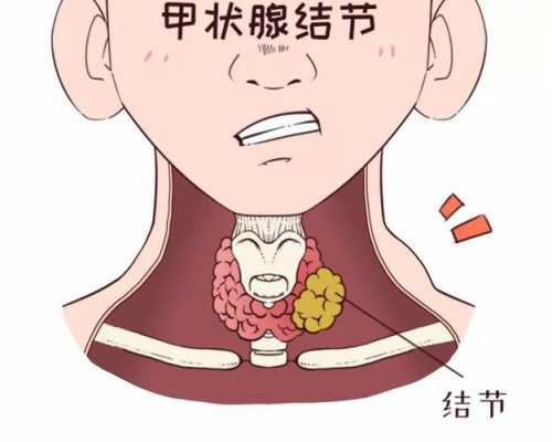  甲状腺结节什么原因引起的「甲状腺结节什么原因引起的 怎样治疗和预防」