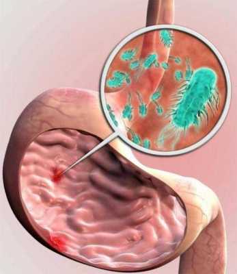 螺旋杆菌是什么,螺旋杆菌是什么病?症状是什么 