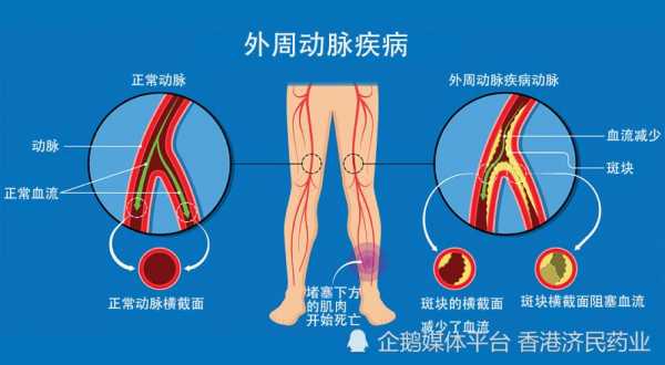 什么是外周血,什么是外周血管病 