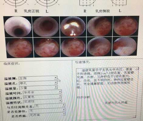 乳头出血水是什么原因