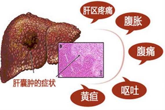 肝囊肿是什么原因造成的严重吗-肝囊肿是什么原因造成的