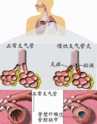 什么是支气管炎咳嗽