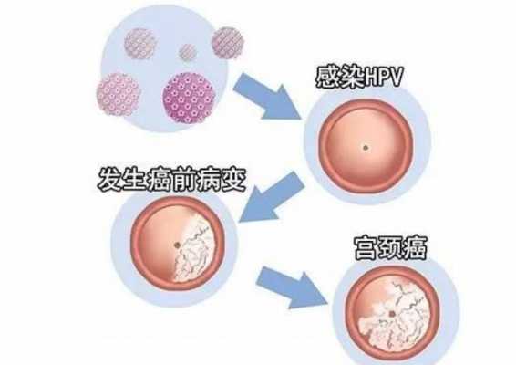  宫颈cin是什么意思「宫颈cin一级是什么意思」