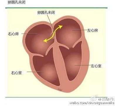 什么是卵圆孔（什么是卵圆孔未闭能愈合吗）