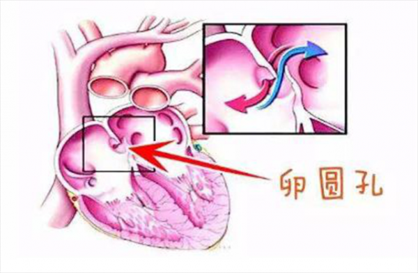 什么是卵圆孔（什么是卵圆孔未闭能愈合吗）