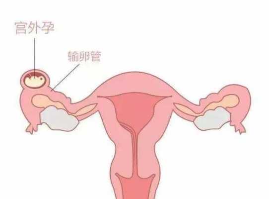 怎么自己判断输卵管是否堵塞 女人不排卵是什么原因造成的