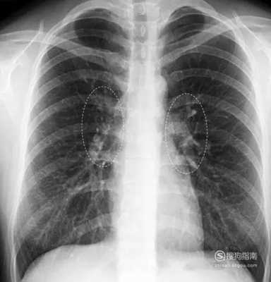 肺纹理是什么意思_肺纹理纹理什么原因造成