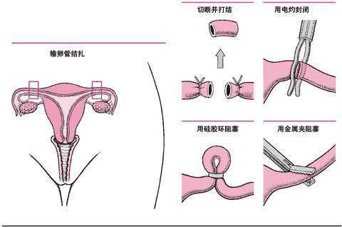 结扎是什么原理