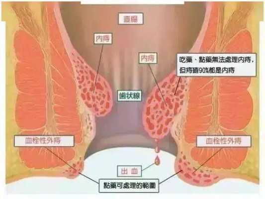 脱肛是什么原因造成的