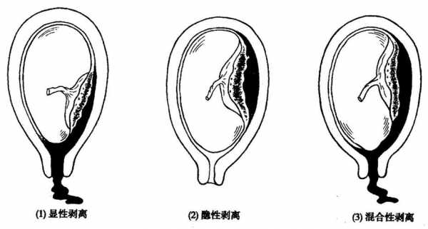 胎盘早期剥离是什么意思 剥离是什么意思