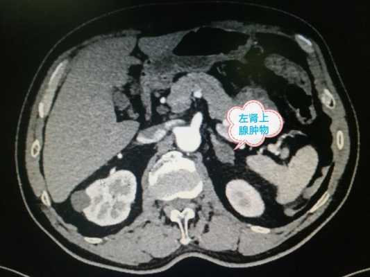 肾腺瘤是什么病