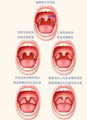 扁桃体为什么会肿大