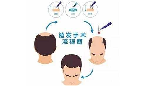 种植头发科学吗-种植头发是什么原理