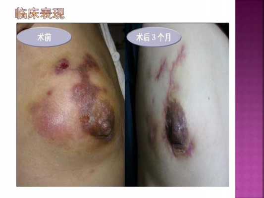 乳腺实性结节是什么意思（乳腺实性结节是什么意思4类）