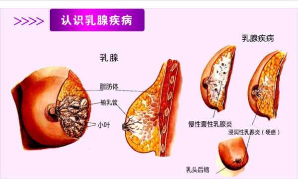 乳腺实性结节是什么意思（乳腺实性结节是什么意思4类）