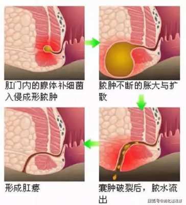 肛瘘和痔疮有区别么