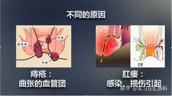 肛瘘和痔疮有区别么