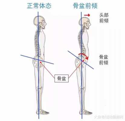 什么是股盆_股盆前倾的图片