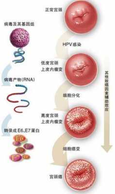  hpv是一种什么病「hpv是一种什么病毒感染」