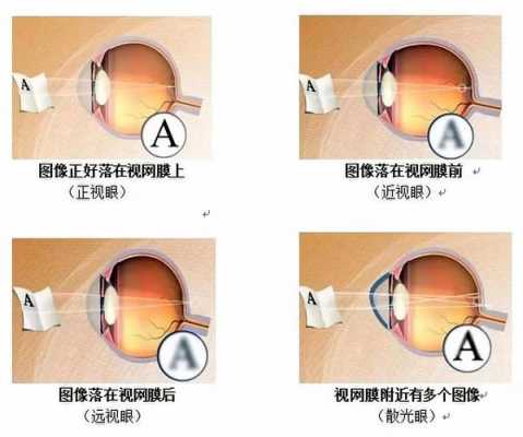 双眼屈光不正需要治疗吗