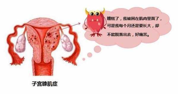 肌腺肌症的症状