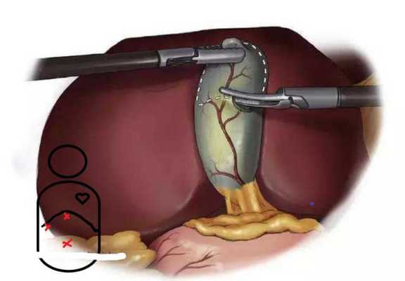 切除胆囊有什么坏处和好处-切除胆囊有什么坏处