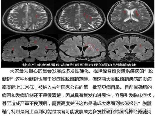 中枢神经脱髓鞘病的症状-中枢神经脱髓鞘病有什么症状