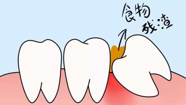 智齿痛是什么原因,智齿痛吃什么 