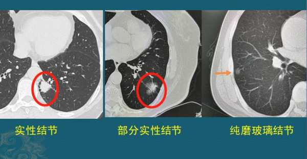  肺淋巴结肿大说明什么「肺淋巴结肿大说明什么意思」