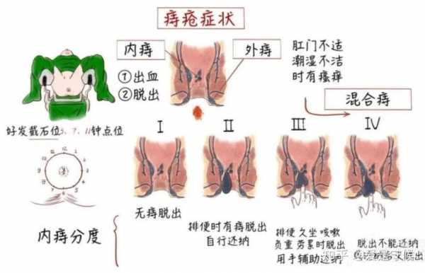 痔疮犯了是什么症状,怎样判断自己得了痔疮 