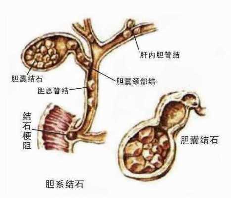 胆总管堵塞有什么症状（胆总管堵死意味着什么）