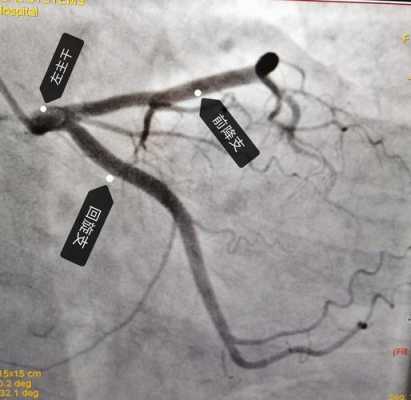  冠脉造影是什么意思「冠脉造影是啥意思」