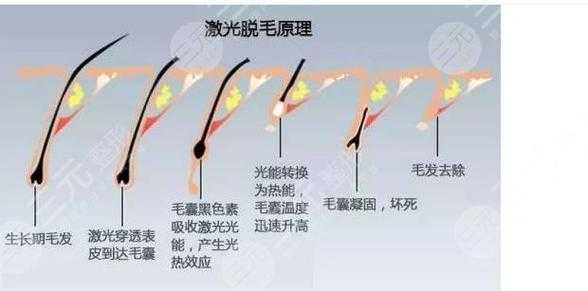 激光脱毛和冰点脱毛有什么区别图片 激光脱毛和冰点脱毛有什么区别