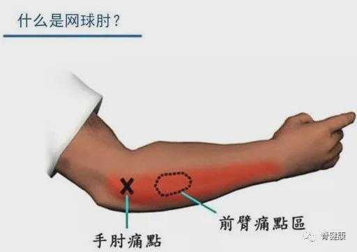 网球肘什么症状它是怎么得的