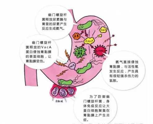  什么是幽门螺杆菌「什么是幽门螺杆菌感染有啥症状」