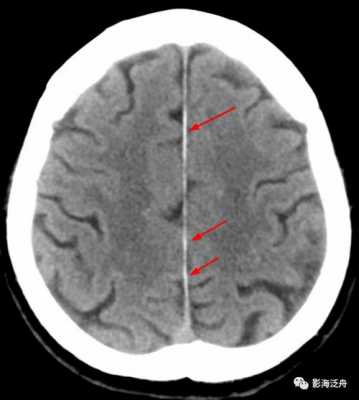 什么叫大脑镰钙化灶