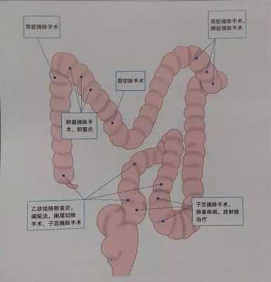  肠粘连是什么原因引起「肠粘连是什么原因引起百度百科」