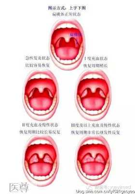  扁桃体发炎挂什么科「儿童扁桃体发炎挂什么科」