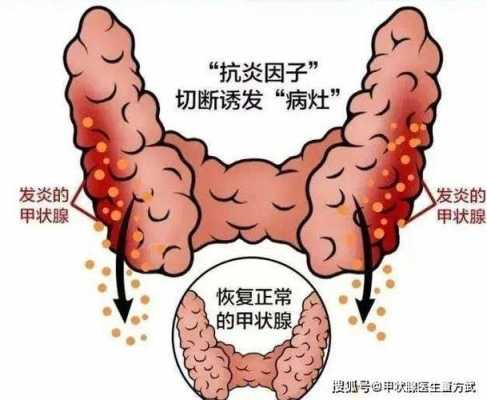 什么是桥本甲状腺炎?如何治疗?-什么是桥本甲状腺炎