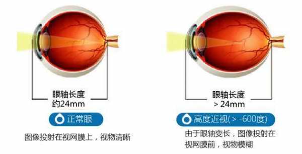 现在近视眼能治好吗-近视眼有什么症状