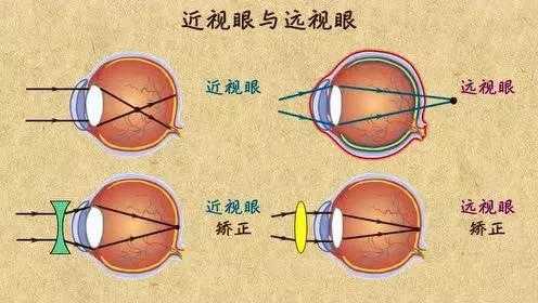 现在近视眼能治好吗-近视眼有什么症状