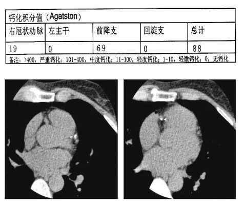 什么是冠状动脉钙化（什么是冠状动脉钙化斑）