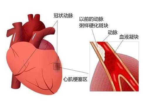 什么是冠状动脉钙化（什么是冠状动脉钙化斑）