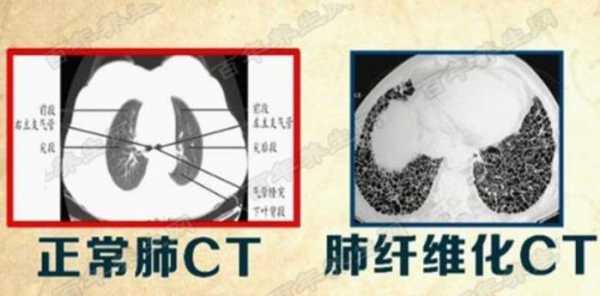 肺纤维化是什么意思?-肺纤维化是什么意思