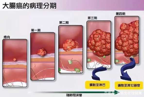  直肠癌是什么原因引起的「直肠癌是什么原因引起的百度知道」