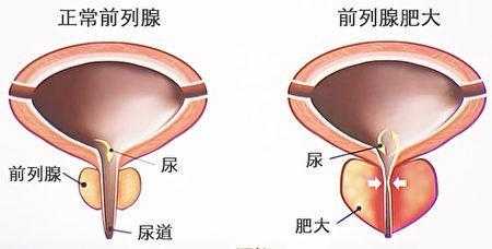 前列腺肥大是什么意思症状? 前列腺肥大是什么意思