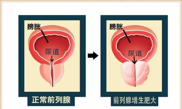 前列腺肥大是什么意思症状? 前列腺肥大是什么意思